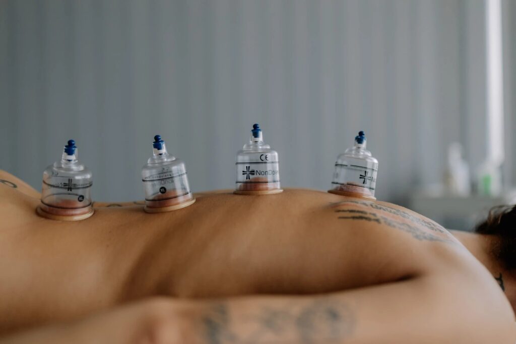 Baňkování (vakuoterapie)