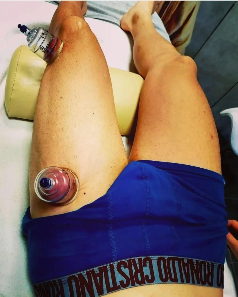 Baňkování Jirkov – vakuoterapie pro regeneraci