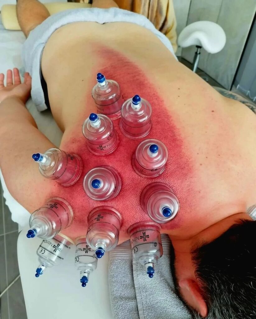 Baňkování Jirkov – vakuoterapie pro regeneraci