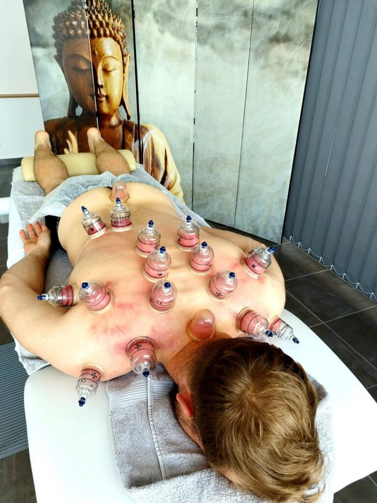 Baňkování Jirkov – vakuoterapie pro regeneraci