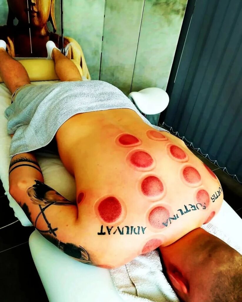 Baňkování Jirkov – vakuoterapie pro regeneraci